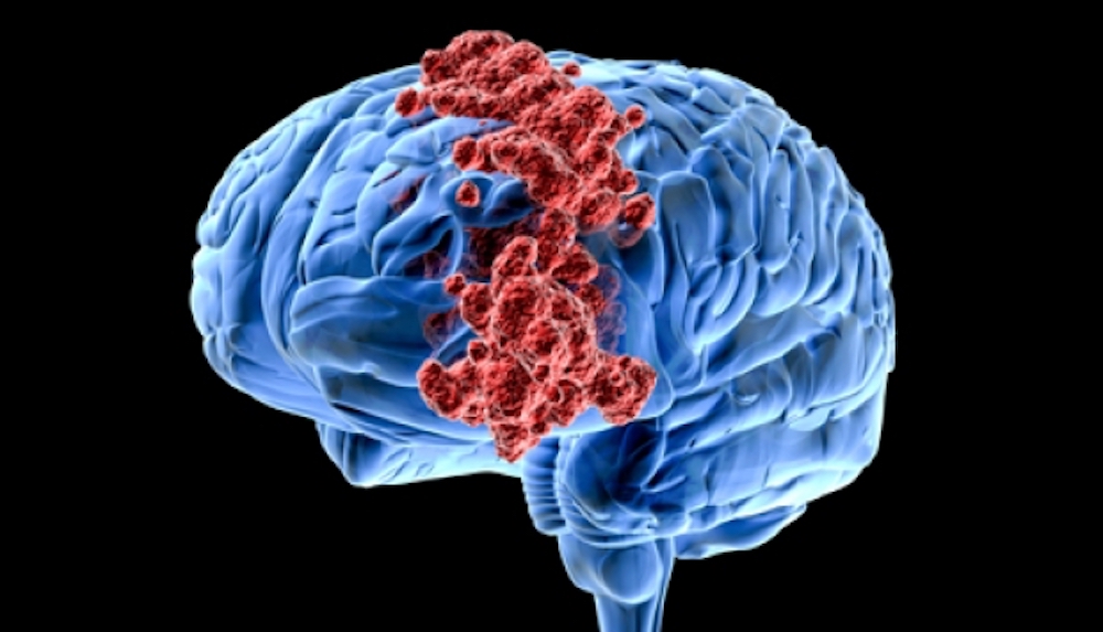 Рак головного мозга: Рак головного мозга: