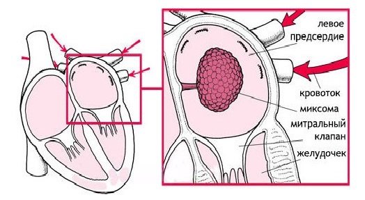 миксома левого предсердия миксома левого предсердия
