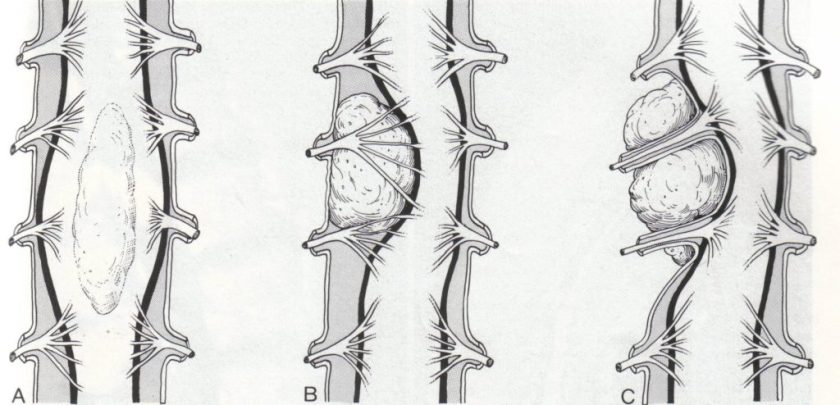 Рак позвоночника Рак позвоночника