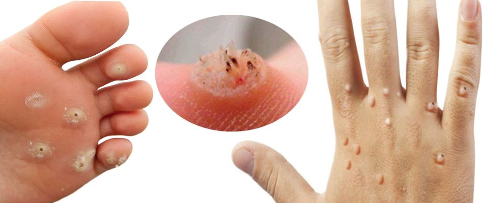 Вирус папилломы человека на руках и ногах