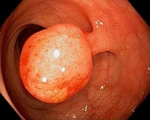 полип полип