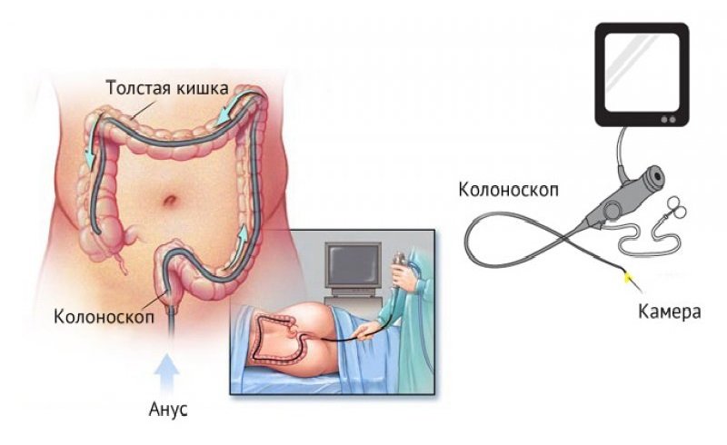 колоноскопия - метод диагностики полипов колоноскопия - метод диагностики полипов