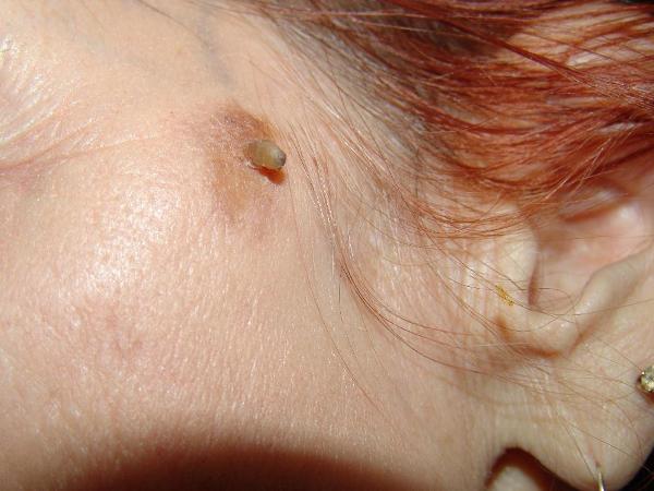 Кожаный Рог заболевание фото Кожаный Рог заболевание фото