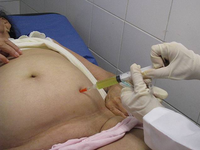 Диагностика асцита Диагностика асцита