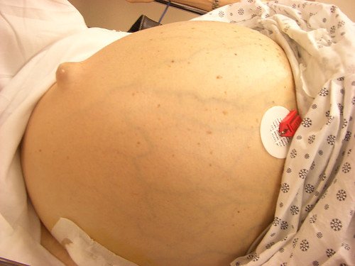 асцит брюшной полости асцит брюшной полости