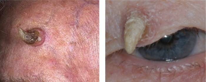 Кожный рог вокруг глаз Кожный рог вокруг глаз