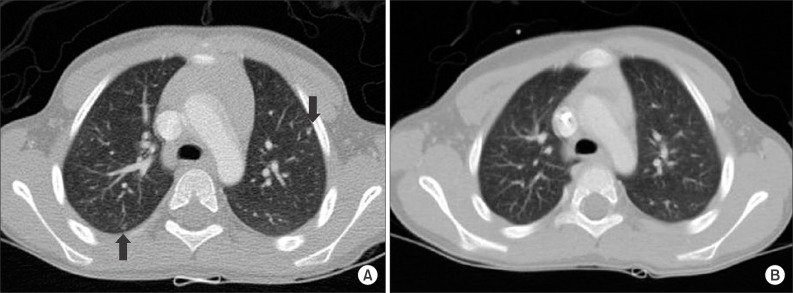 Опухоль вильмса у детей последняя стадия Опухоль вильмса у детей последняя стадия