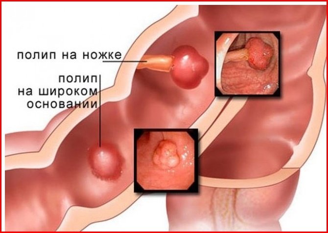 полипы в кишечнике полипы в кишечнике
