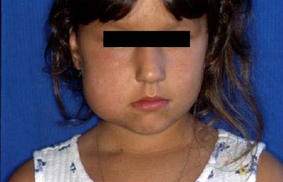 Лимфангиома Лимфангиома