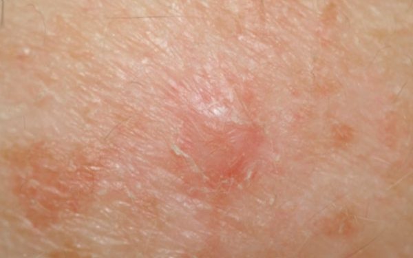 Бесцветная меланома Бесцветная меланома