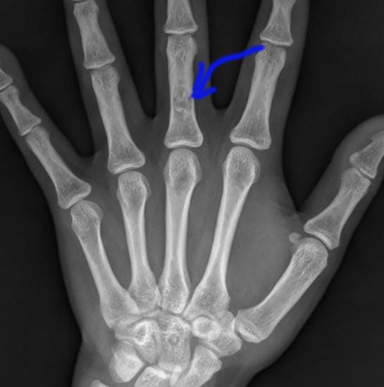 Экхондрома костей кисти Экхондрома костей кисти