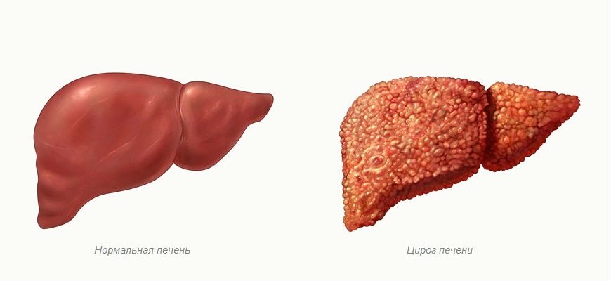 Цирроз печени Цирроз печени