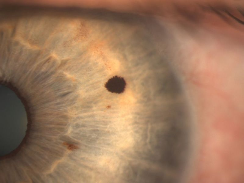 Пигментные пятна (невусы) на глазной оболочке Пигментные пятна (невусы) на глазной оболочке