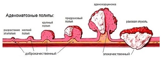 Аденоматозные полипы Аденоматозные полипы