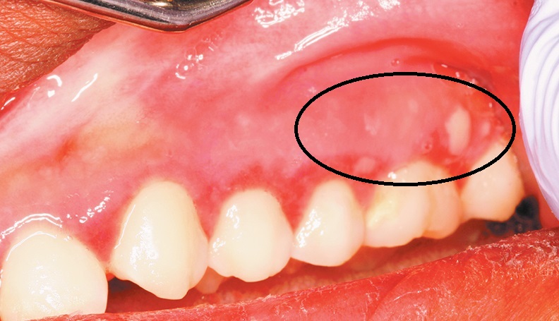 язвочки - симптом рака десны язвочки - симптом рака десны