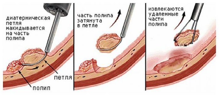 Удаление полипов Удаление полипов