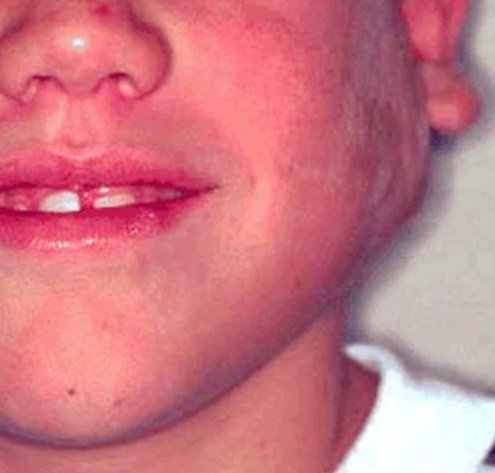 Рабдомиосаркома Рабдомиосаркома