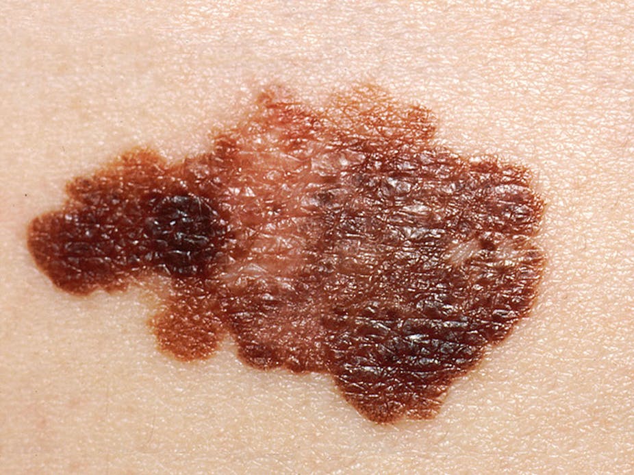 Рак кожи Рак кожи