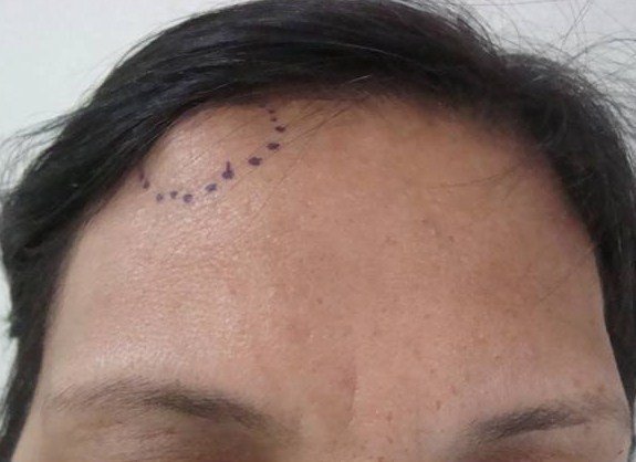 Остеома на лбу Остеома на лбу