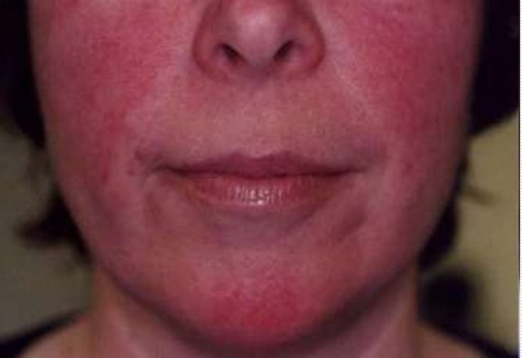 Приливы крови и покраснение лица (гиперемия) у женщины на лице фото Приливы крови и покраснение лица (гиперемия) у женщины на лице фото