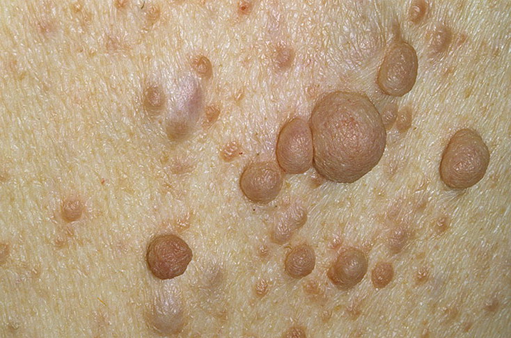 Нейрофиброма Нейрофиброма