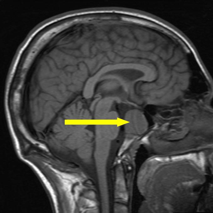 микроаденома гипофиза что это микроаденома гипофиза что это