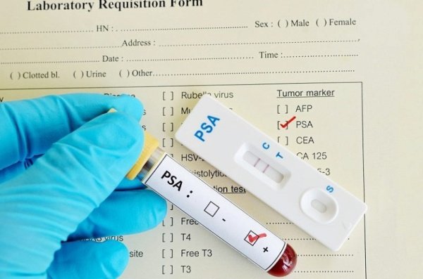 Онкомаркеры для мужчин Онкомаркеры для мужчин