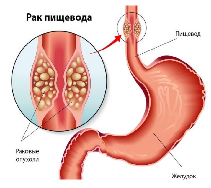 Рак пищевода Рак пищевода