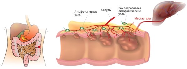 Рак ободочной кишки Рак ободочной кишки