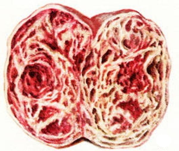 Хорионэпителиома и рак яичка Хорионэпителиома и рак яичка