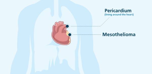 Мезотелиома сердца (перикарда) Мезотелиома сердца (перикарда)