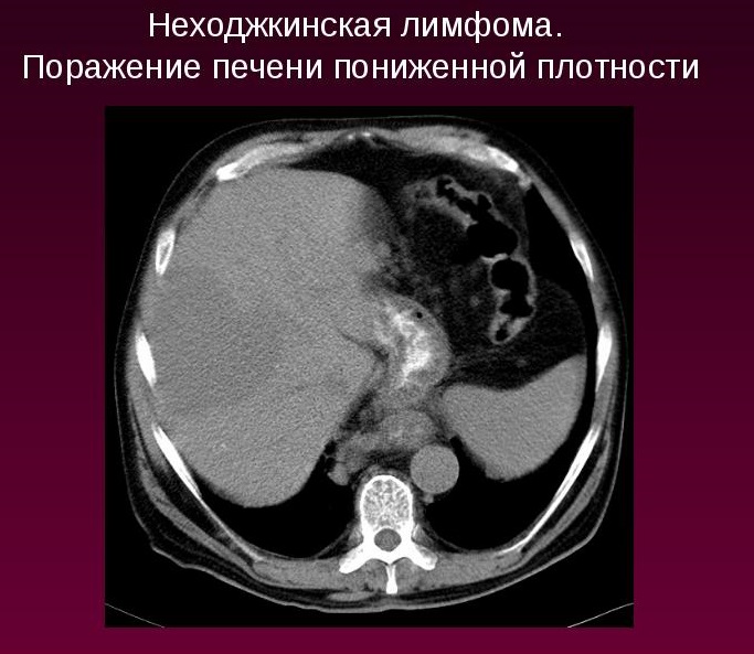 Неходжкинская лимфома Неходжкинская лимфома