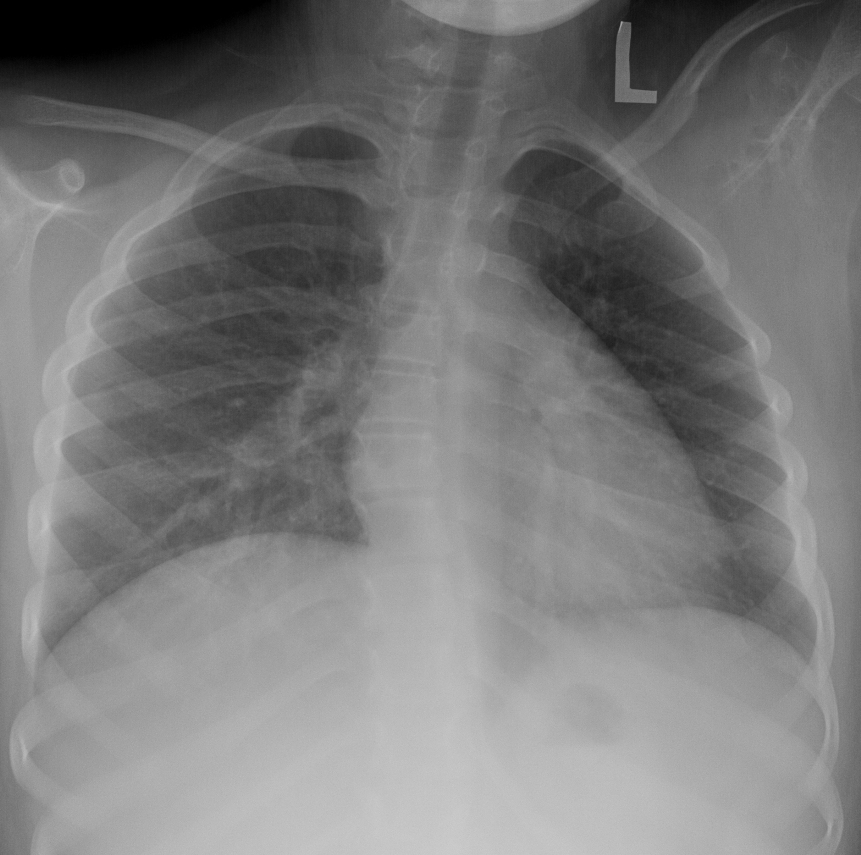 Фиброматоз легких Фиброматоз легких