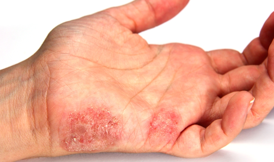 Болезнь Боуэна на ладонях. Фото Болезнь Боуэна на ладонях. Фото