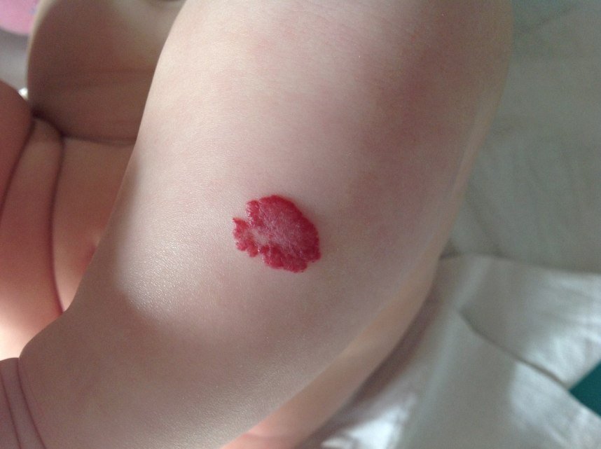 Гемангиома на голени у ребенка Гемангиома на голени у ребенка