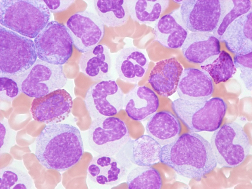 Кровь пациента с хроническим миелобластным лейкозом Кровь пациента с хроническим миелобластным лейкозом