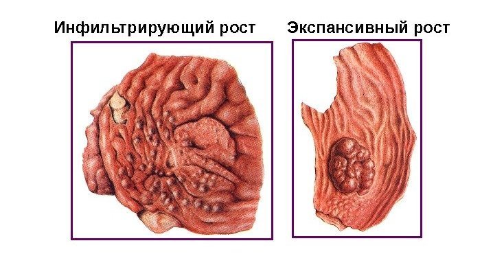 Экспансивный и инфильтративный рост опухоли Экспансивный и инфильтративный рост опухоли