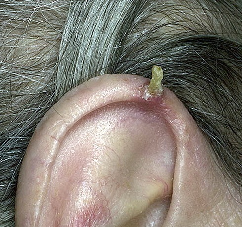 кожный рог на ухе