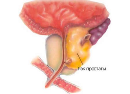 рак простаты рак простаты