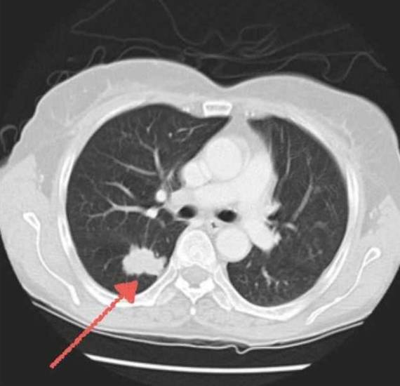 Аденокарцинома правого легкого Аденокарцинома правого легкого