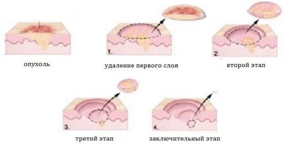 удаление базалиомы удаление базалиомы
