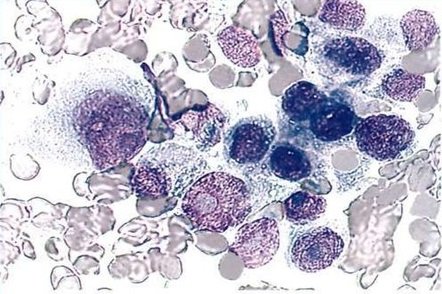 низкодифференцированная аденокарцинома низкодифференцированная аденокарцинома