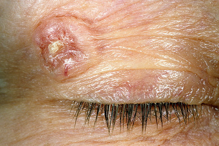 базалиома века базалиома века