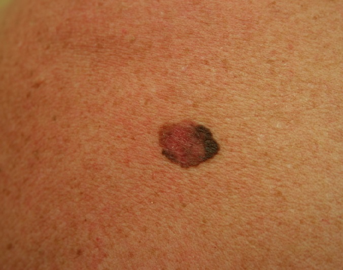 Меланома Меланома