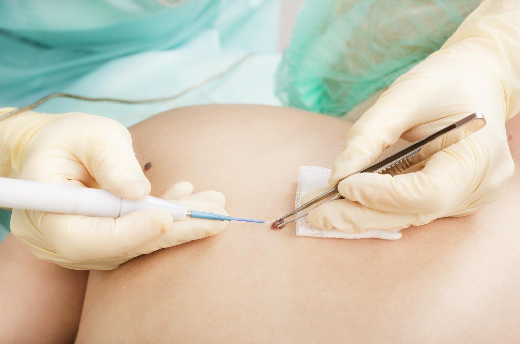 Биопсия новообразования Биопсия новообразования