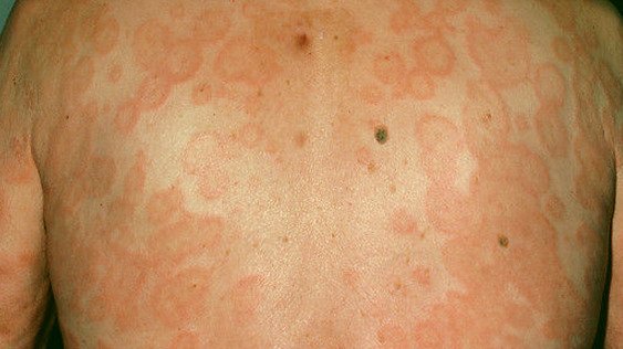 Эритема. Осложнения лимфосаркомы Эритема. Осложнения лимфосаркомы