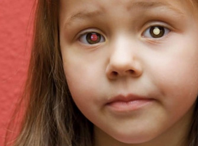 Ретинобластома у детей Ретинобластома у детей