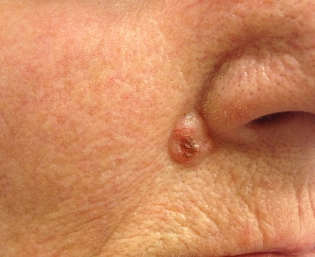 Базалиома Базалиома