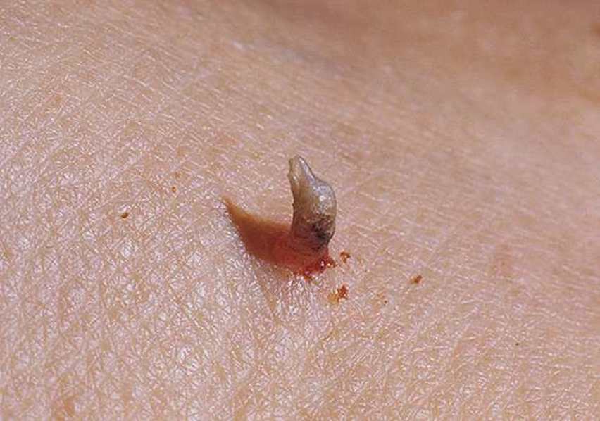 Рог на коже Рог на коже