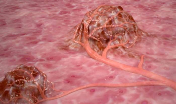 Метастазы Метастазы